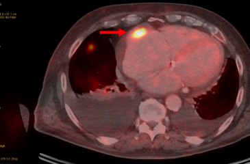 Cas clinique : TEP SCANNER réponse