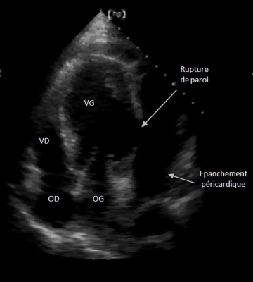 Cas clinique : Coeur fragile réponse 1