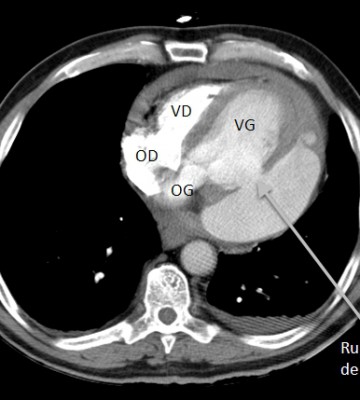 Cas clinique : Coeur fragile réponse 2