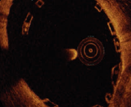 stent_resorbable_jeanneteau