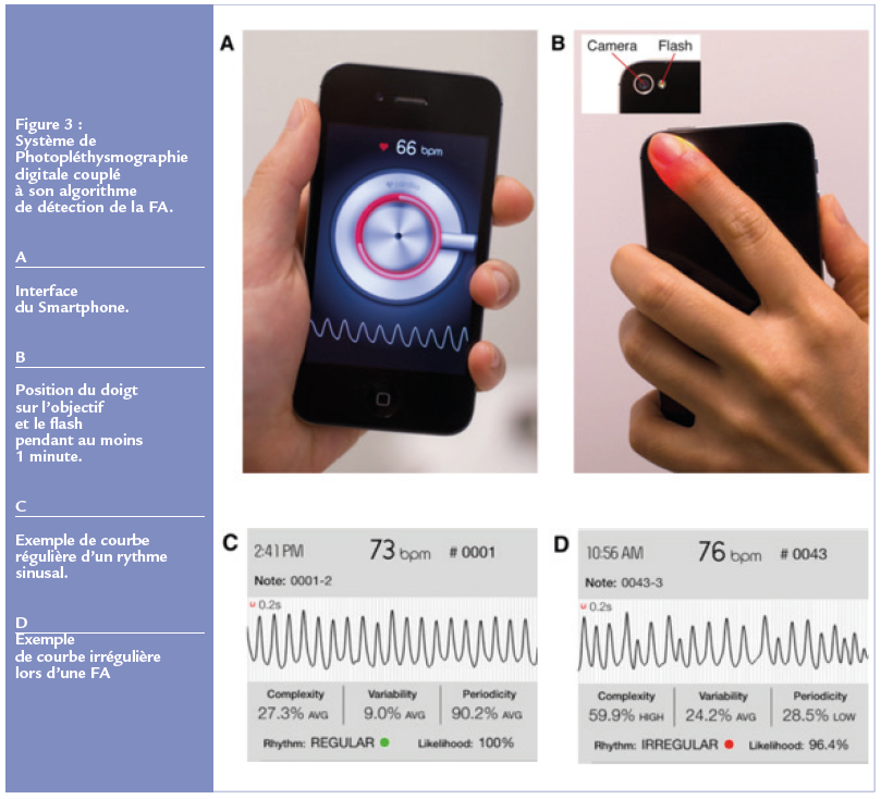 Fibrilation artiale - Figure 3