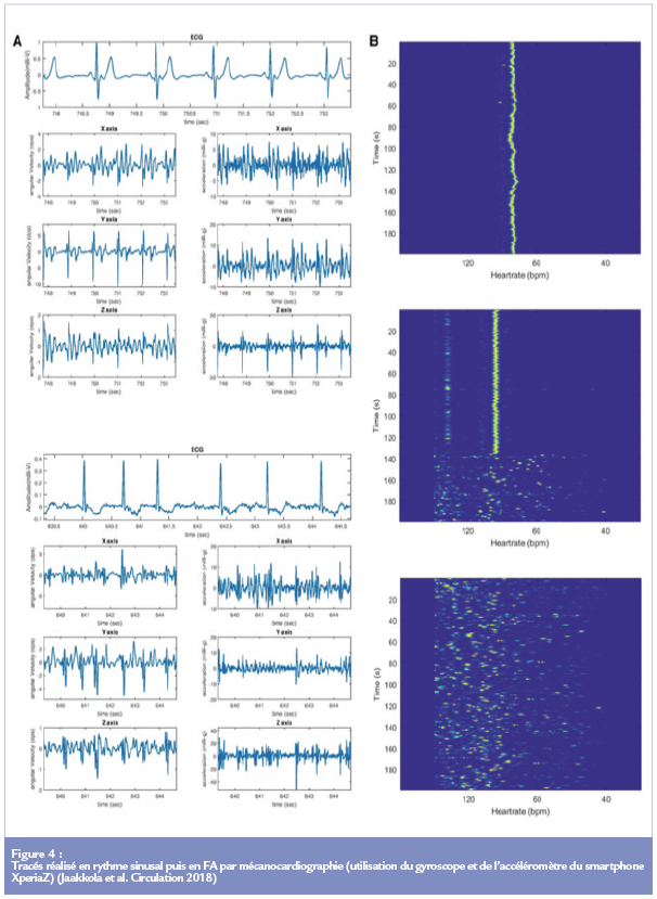 Fibrilation artiale - Figure 4