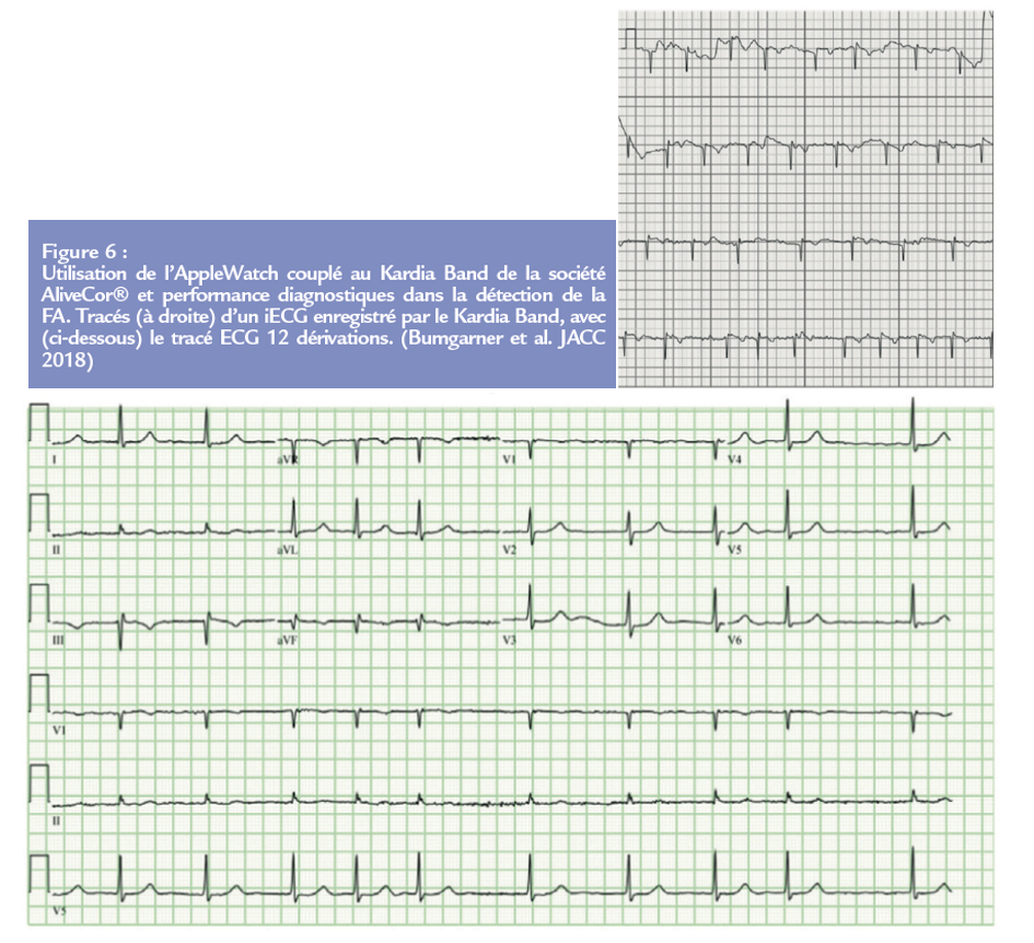 Fibrilation artiale - Figure 6